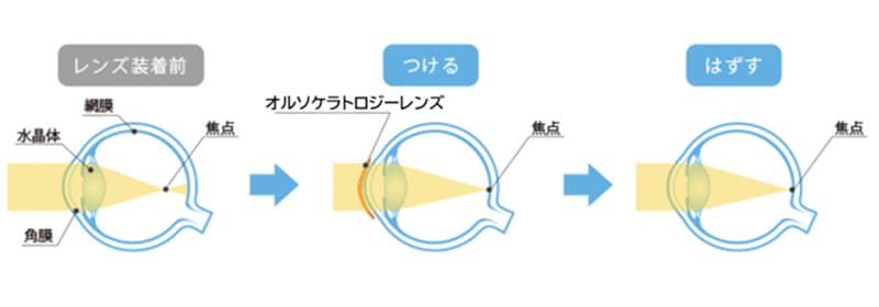 オルソケラトロジーレンズの原理イメージ図