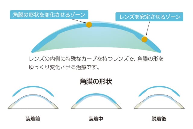 オルソケラトロジーレンズの仕組み